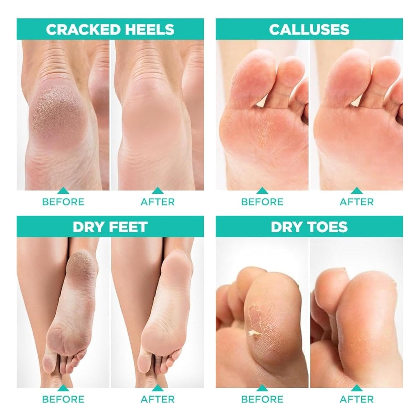 Meditive Exfoliating Foot Mask - Peeling Foot Mask for Dead Skin Removal, Callus & Cracked Heel Repair, Foot Care Treatment, Softens & Smoothens Feet, Foot Spa Mask for Dry, Rough, and Cracked Feet– 2 Pair (ROSE)