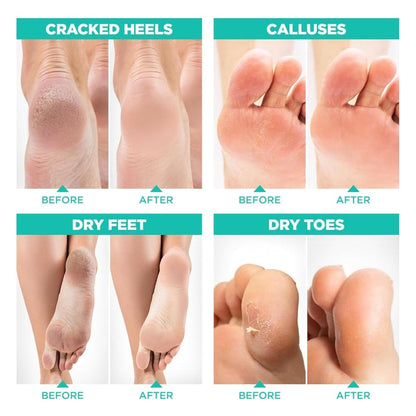 Meditive Exfoliating Foot Mask - Peeling Foot Mask for Dead Skin Removal, Callus & Cracked Heel Repair, Foot Care Treatment, Softens & Smoothens Feet, Foot Spa Mask for Dry, Rough, and Cracked Feet– 2 Pair (ROSE)